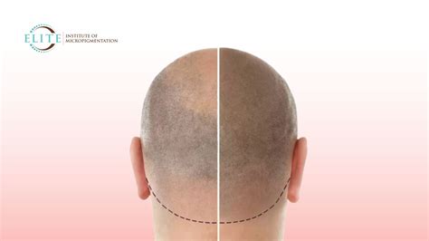 scalp micropigmentation wimbledon|Everything You Need to Know About Scalp .